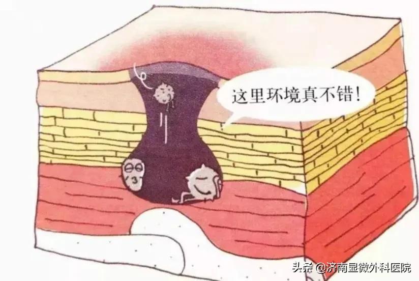 压疮分期与护理方法解析