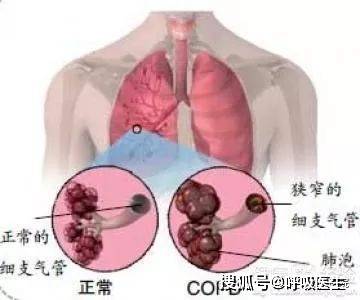 慢阻肺治疗最新药物进展及新药解析