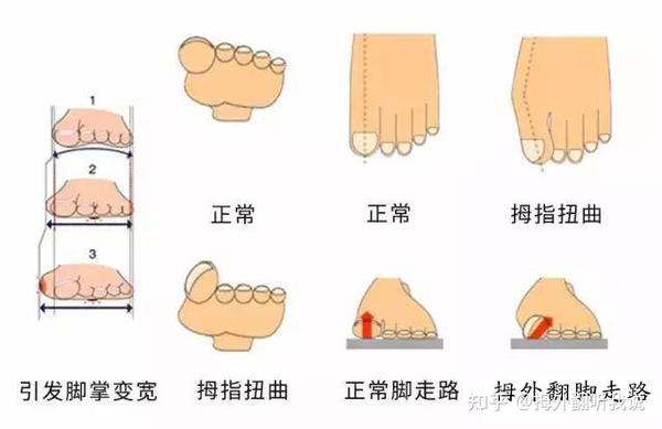 最新脚拇指外翻治疗新方法及策略探讨